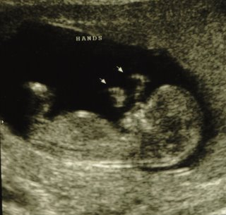 Fetus, Fetal, Development, Pregnancy, Abortion, Weeks, 12, Pro-Life, Pro-Choice 